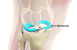 meniscal surgery