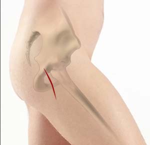 Posterior Hip Replacemnet