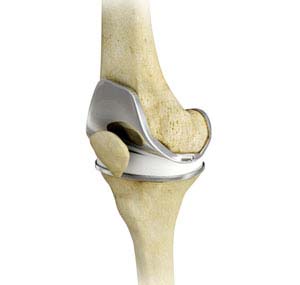 Total knee Replacemnet