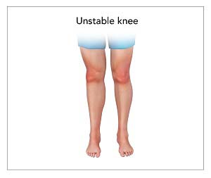 Unstabl Knee