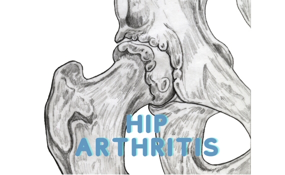 Hip Osteoarthritis