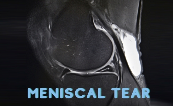 Meniscal Tear