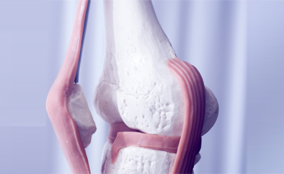 Knee arthritis