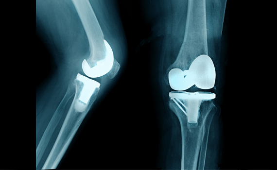 Knee Replacement