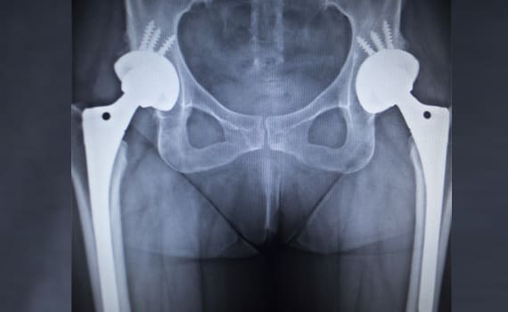 Hip Replacement